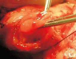 Хирургия язвенного участка 12-перстной кишки