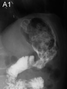 Рентгенодиагностика желудка