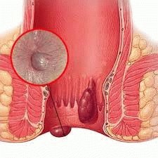 Воспаление геморроидальных вен