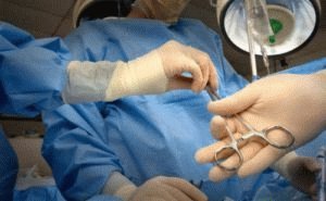 Оперирование геморроидальных узлов