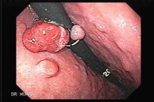 Гиперплазиогенные полипы желудка