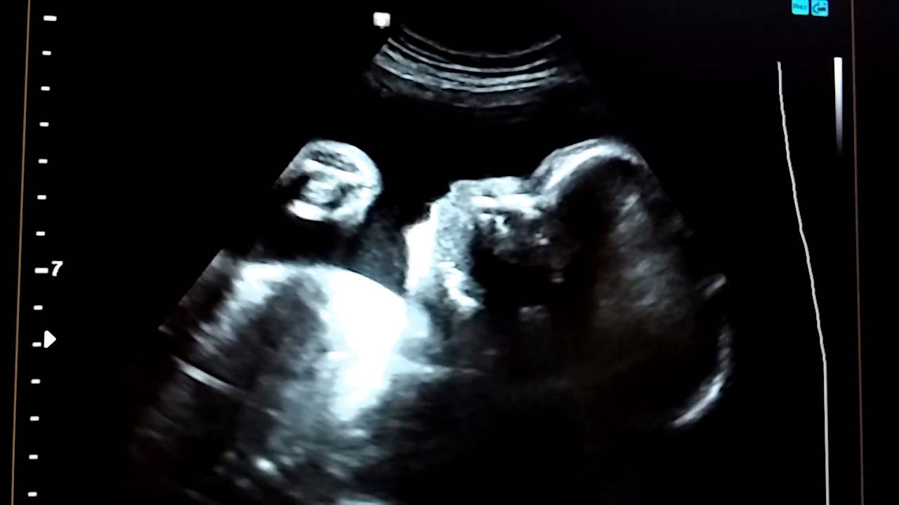 Почему в утробе матери икает. УЗИ малыша сосущего палец. Младенец в утробе сосущий палец.