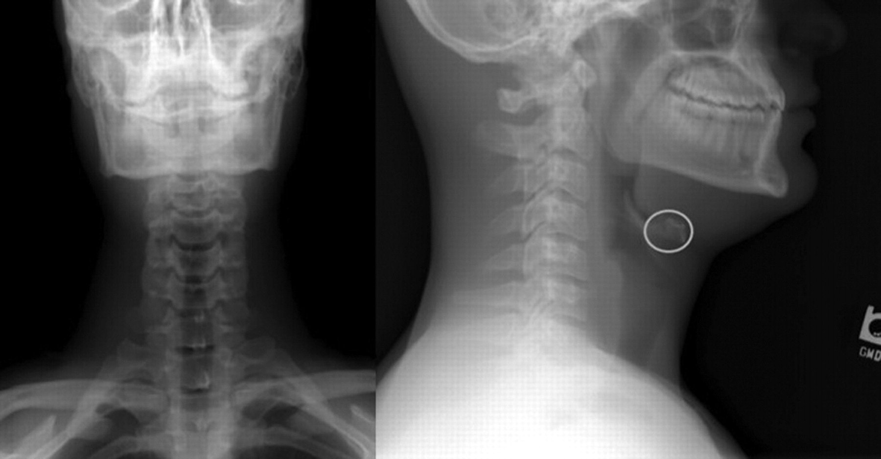 Сухой горловой. Перелом подъязычной кости рентген. Перелом хрящей гортани рентген. Перелом подъязычной кости на кт.