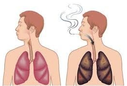 Лёгкие здорового человека и курильщика