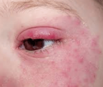 Аллергические прыщи и красные глаза