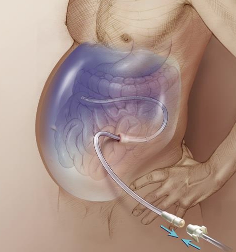 Асцит брюшной полости при онкологии яичников