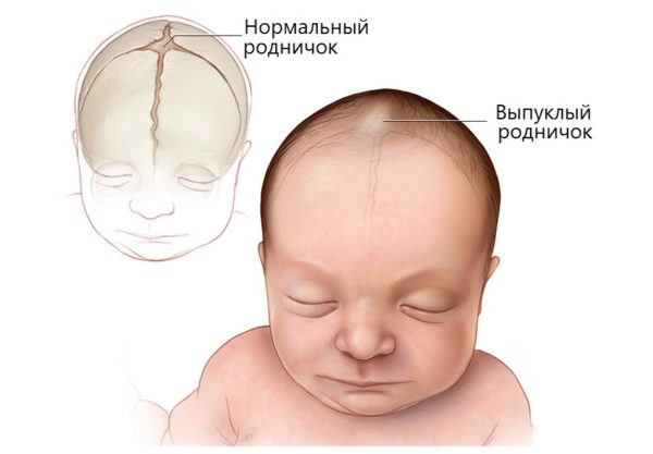 Симптом гипервитаминоза у младенца